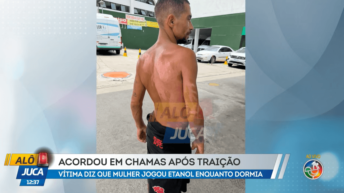 Imagem de ACORDOU EM CHAMAS: Homem diz que teve corpo incendiado pela companheira após traição
